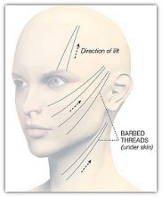 Tratamiento de medicina estética facial Lifting Suave Con Hilos Lift