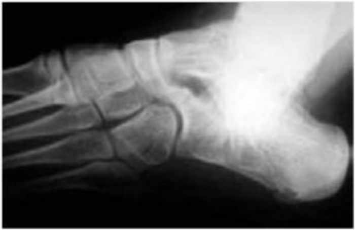 El objetivo del tratamiento de la Coaliciones Tarsales es limitar el dolor y restaurar el movimiento; por tanto, el tratamiento sólo está indicado cuando la coalición es sintomática.