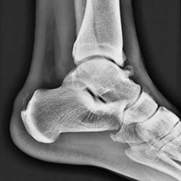 Los pacientes con Síndrome de Pinzamiento Anterior de Tobillo normalmente refieren una progresión lenta del dolor, con periodos de mejoría con el reposo