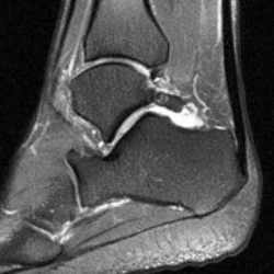 Inicialmente como en la mayoría de las lesiones el tratamiento del Síndrome posterior de tobillo es conservador