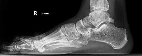 El dolor es la manifestación constante de los pacientes que presentan la lesión o Síndrome de Pinzamiento Posterior de Tobillo.