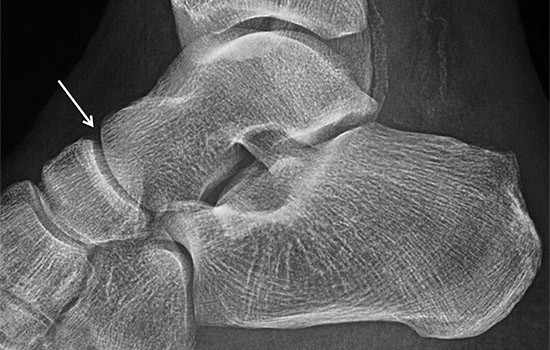 La afectación por artrosis de la articulación Astrágalo Escafoidea es poco frecuente de forma aislada. Se ve con frecuencia en grado leve en pacientes con artrosis de otras articulaciones del pie y tobillo