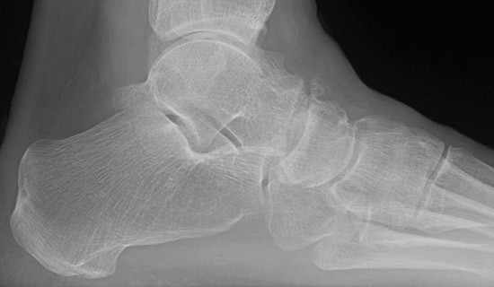 El estudio de imagen con rayos X es suficiente para identificar el problema y confirmar el diagnóstico de la artrosis Astrágalo Escafoidea