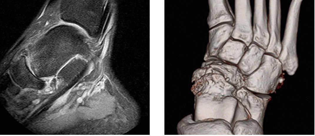 Radiografía Lateral. Artrosis Astragalo-escafoidea