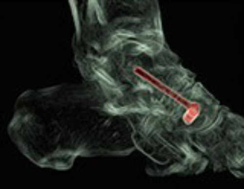 si el tratamiento conservador anteriormente descrito no es eficaz en el control del dolor recomendamos la cirugía que consiste en la artrodesis astragaloescafoidea