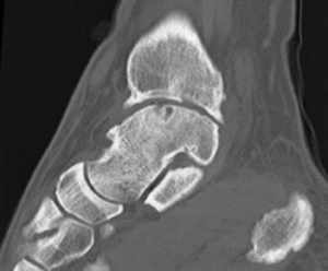 las medidas higiénicas y conservadoras pueden ralentizar la progresión de la artrosis de tobillo