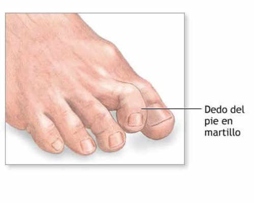 los dedos en martillo generalmente se inician como deformaciones leves y empeoran progresivamente con el tiempo