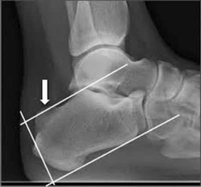 El tratamiento con ortesis plantar personalizada puede aliviar en gran medida el dolor asociado a la deformidad de Haglund por medio de la estabilización del talón