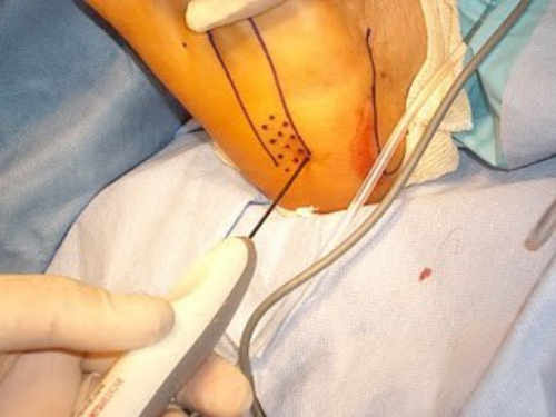 Coblación. Técnica Topaz para la Fascitis Plantar