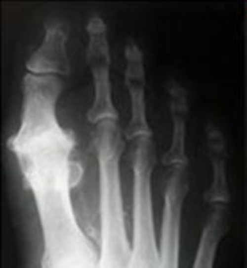 El diagnóstico del Hallux Rigidux se confirma con una exploración clínica junto con radiografías que evidencian una degeneración articular y proceso artrósico