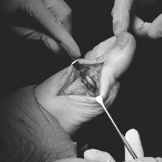 Técnica con implante completo para el tratamiento del Hallux Rigidux en el Centro Clínico Quirúrgico de Aranjuez