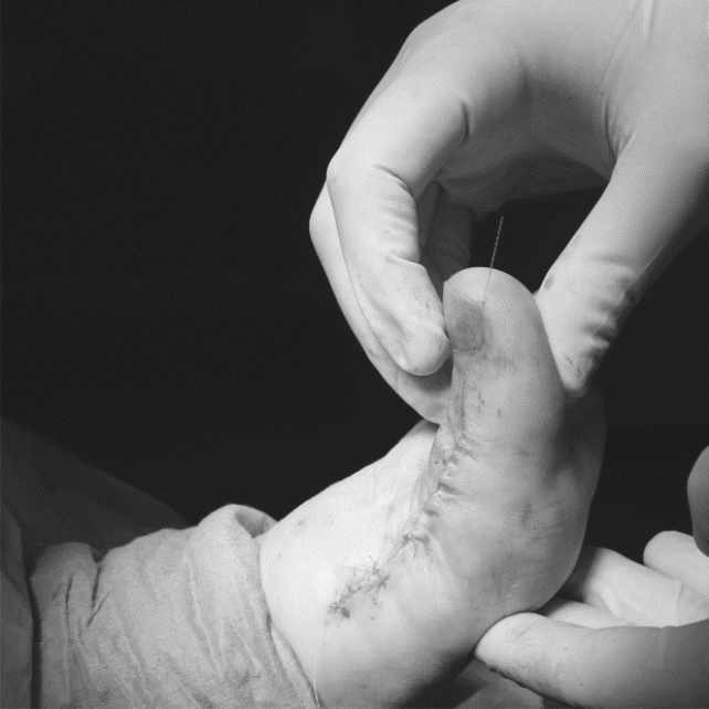 Resultados de Implante completo en paciente con Hallux Rigidux