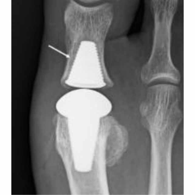 Radiografía de Implante completo en paciente con Hallux Rigidux