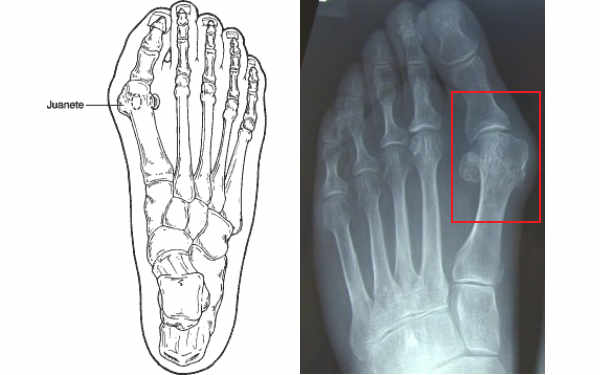 es frecuente en el hallux valgus la aparición de una bolsa medial a la prominencia de la articulación debido a la presión ejercida por un calzado ajustado que puede ser dolorosa