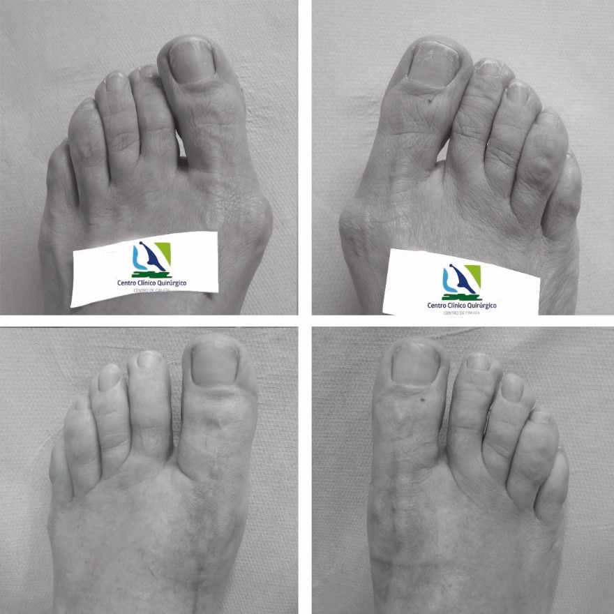 El tratamiento quirúrgico del hallux valgus o juanete será de elección cuando el dolor impida una vida normal y el tratamiento conservador no haya sido eficaz. El objetivo del tratamiento quirúrgico será la eliminación del crecimiento excesivo del hueso