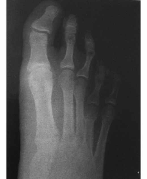 Radiografía de paciente con metatarsalgia previa a someterse a Cirugía