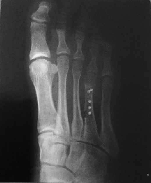 Radiografía de Postoperatorio alargamiento con injerto óseo y mini tornillos canulados.