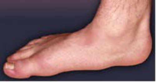 Antes de la Cirugía del Pie Plano Flexible