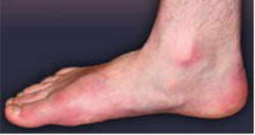 Después de la Cirugía del Pie Plano Flexible