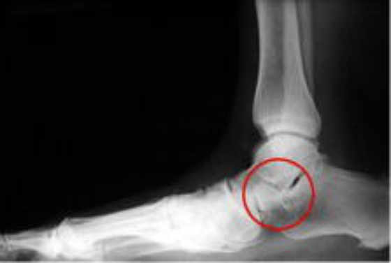 Seno Del Tarso anormal en pie plano flexible