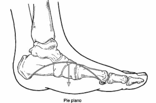 En los casos en los que el pie plano en adulto adquirido ha avanzado sustancialmente o no ha mejorado la sintomatología con tratamiento conservador, es necesario recurrir a la cirugía. Para algunos casos avanzados, la cirugía es la única opción.