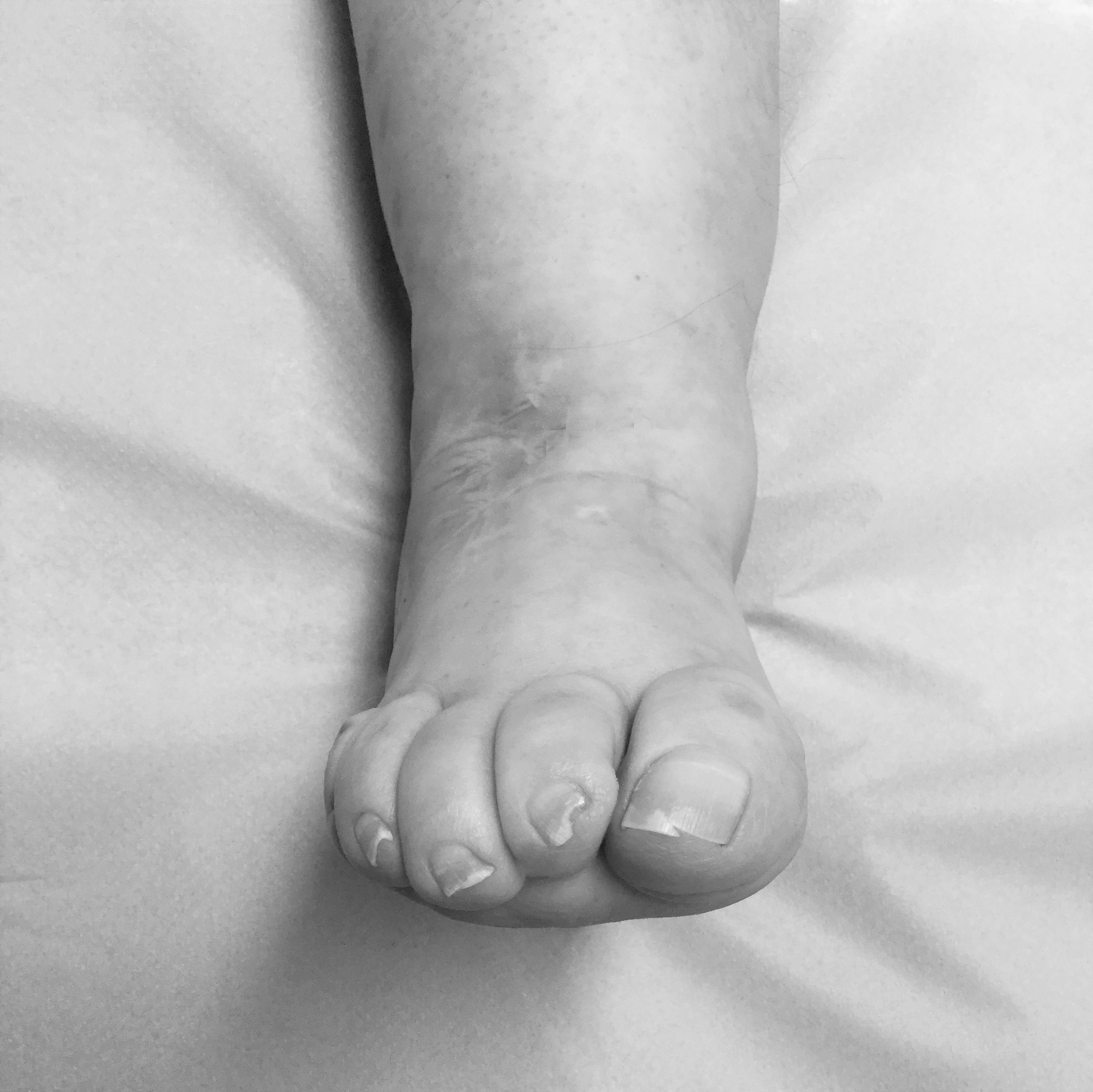 Paciente con pie equino varo. Imagen postquirúrgica a los 5 meses