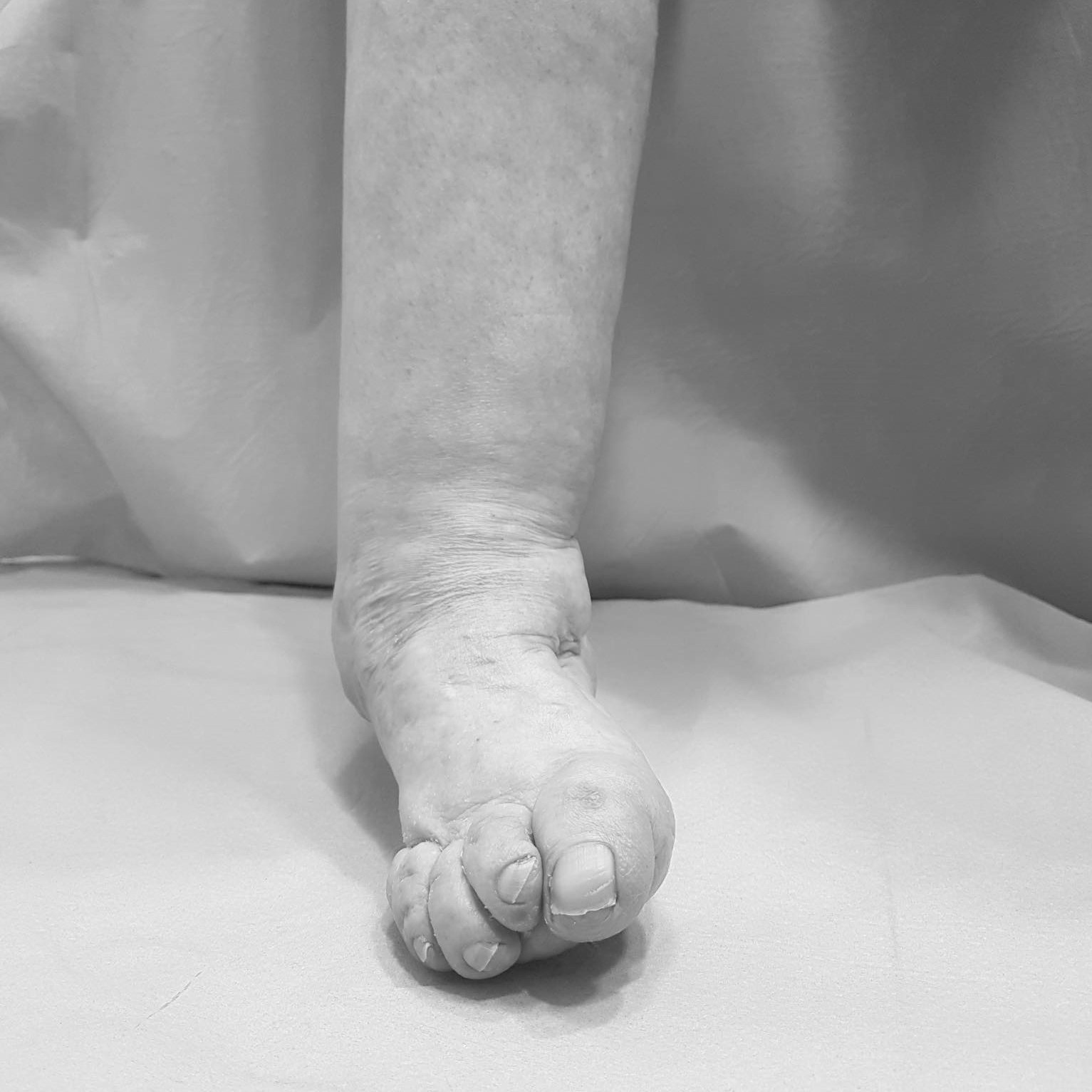 Paciente con pie equino varo. Imagen preoperatoria