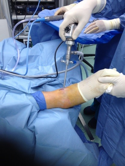 artroscopia de tobillo