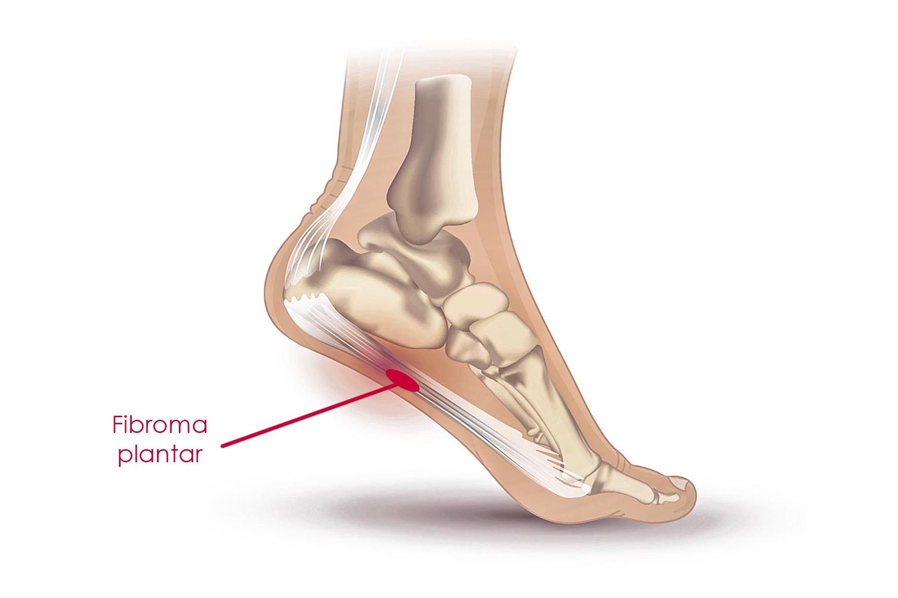 fibromatosis plantar