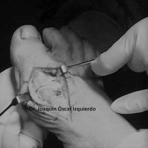 hemiimplante de Hallux Rigudux