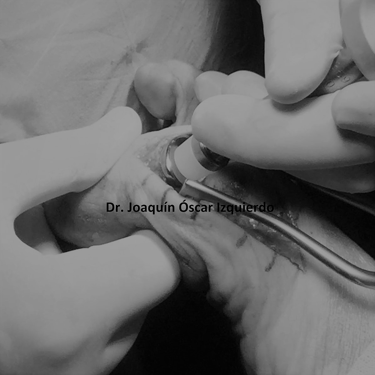 hemiimplante de Hallux Rigudux