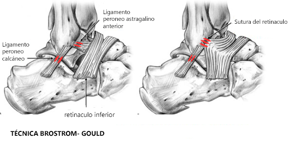 inestabilidad crónica de tobillo
