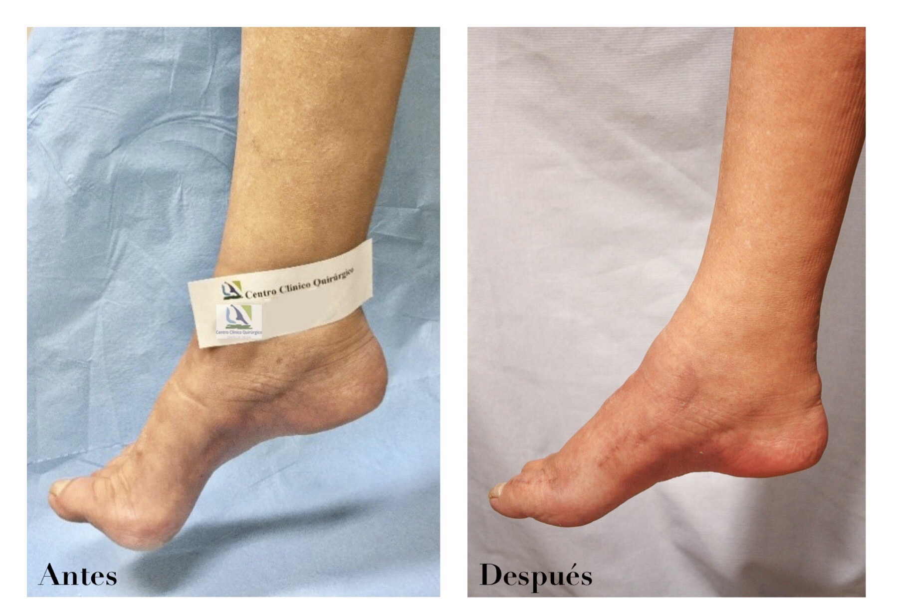 transposicion tendinosa en el tobillo y pie