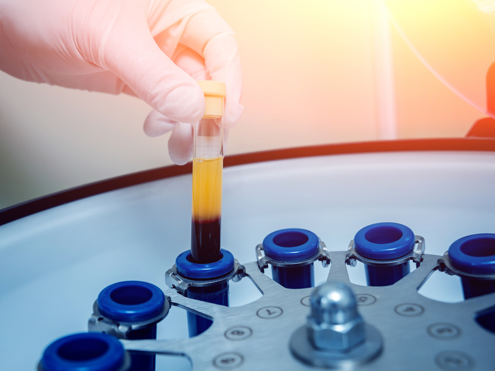 Tratamiento capilar PRP