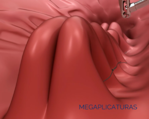 Megaplicaturas. Método MEGA