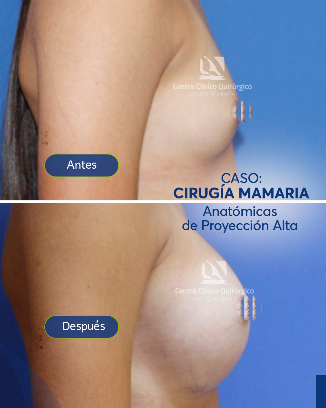 Antes y después implantes anatómicos proyección alta — caso 2