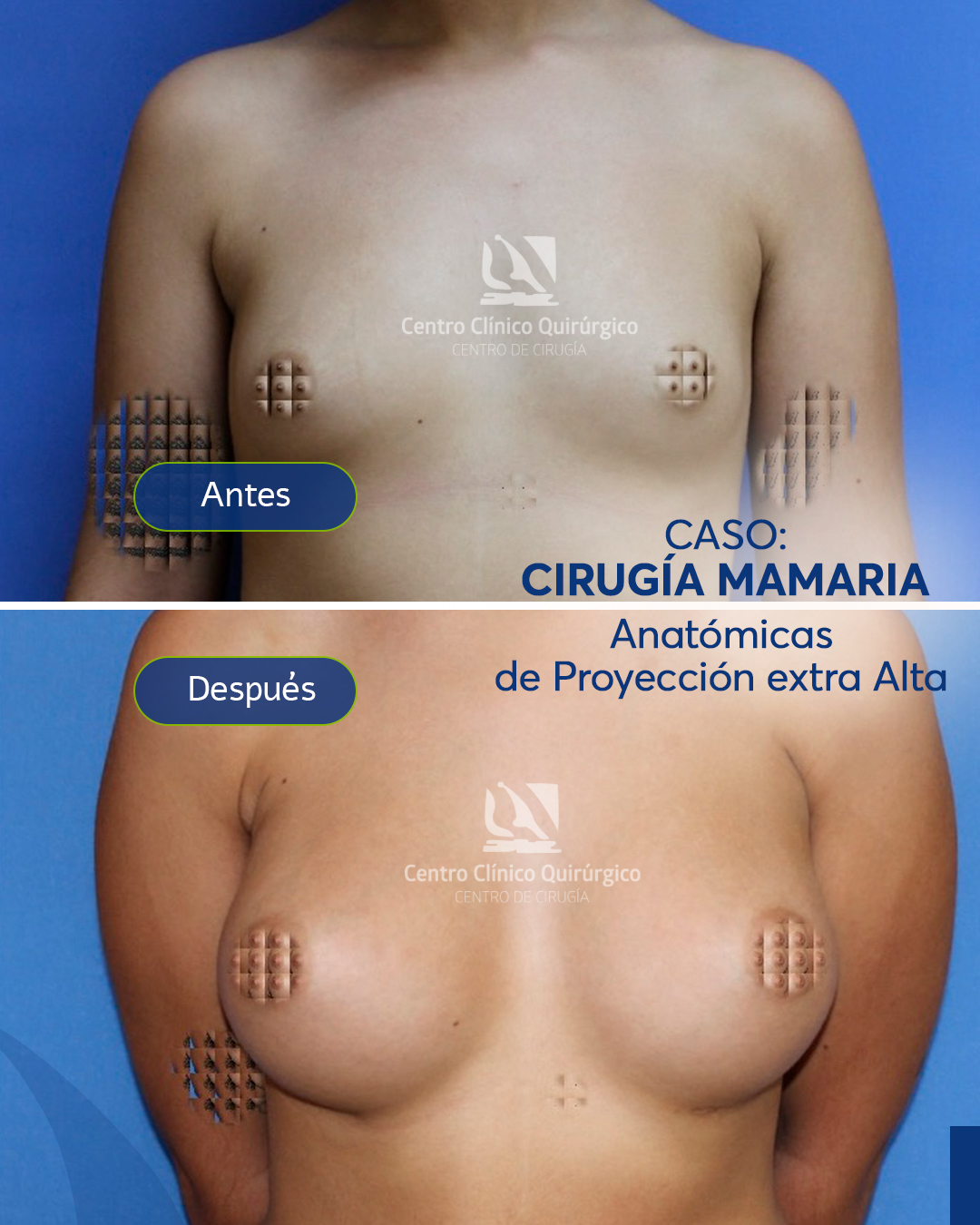 Antes y después implantes anatómicos proyección alta — caso 7